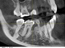 Cone Beam CT: 2-D Imaging Is No Comparison