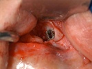 Implant In Infection Sites