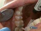 Case Study: Total Etch Procedure by Dr. Mirzayan Using OptiBond and NX3 Application