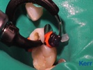 Case Study: Posterior Maxillary Pre-Molar Procedure by Dr. Hornbrook Using SonicFill
