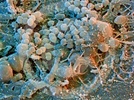 Plaque Linked to Premature Cancer Death
