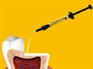 Product Overview: TheraCal LC Light-Curable Restorative
