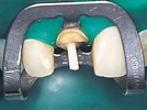 Study Pits Carbon Fiber Posts Against Zirconia