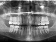 Case Study: Using Cone Beam CT to Save Your Patients Time, Energy, Money and Fear