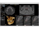 UNC School of Dentistry Benefits From Carestream Dental’s Donation of a CS 9300 Cone Beam System