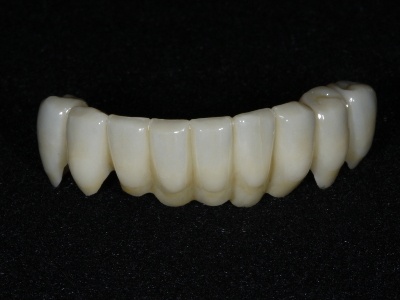Using e.Max Press-to-Zirconia for Strength and Esthetics