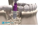 Product Overview: Trabecular Metal Dental Implant System from Zimmer Dental