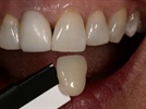 Sending the Patient to the Lab vs. Shooting Pictures Chairside: Tips for Successfully Communicating Shades in the Anterior Esthetic Zone