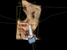 Digital Workflow to Maximize Your Cone Beam Investment: An Implant Case Study