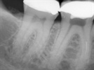 Separation Anxiety: A Case Study Illustrating Removal of a Separated RNT Endodontic File – Part 1 of 2