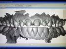 If Not Now, What’s Holding You Back? The Dental Lab Perspective on Digital Impressions