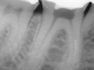 Separation Anxiety: A Case Study Illustrating Removal of a Separated RNT Endodontic File – Part 2 of 2
