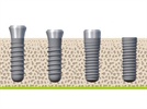 Close to 100% Success Rate for Straumann SLA Dental Implants in Large Scale 10-Year Study