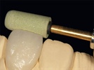 New Dental Product: Dura-Green DIA
