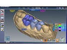 CAD/CAM Provides Good Margins Even for Bad Preps