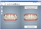 New Dental Product: Invisalign Outcome Simulator