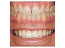 New Dental Product: Obsidian Lithium Silicate Ceramic Crowns from Glidewell Laboratories
