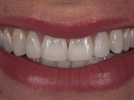 Direct Resin Versus Porcelain: How to Choose the Best Restorative Approach