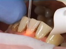 Hygienists, Dentists and Diode Lasers the Perfect Trifecta in Dentistry