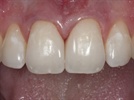 A Simple Approach to Composite Diastema Cases