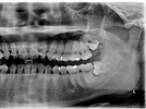 Dental Anesthesia Could Halt Development of Wisdom Teeth