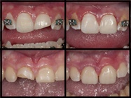 Using Dental Composite to Quickly Repair Class IV Fractures