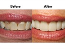 A Simple Cosmetic Dentistry Alternative