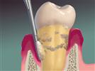 What is Root Planing? Can’t I Just Have my Teeth Cleaned?