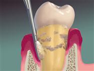 What is Root Planing? Can’t I Just Have my Teeth Cleaned?