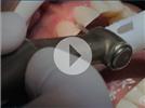 Video: Herculite Ultra Anterior Restoration with Dr. LeSage
