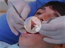 Video: Invisalign and an Implant: Justin's Case