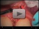 Video: AMD LASERS - Frenectomy Using the AMD LASERS Picasso Diode Laser