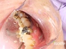 Case Study: Dental CAD/CAM with i2 Dryfield Illuminator