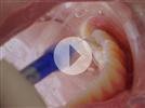 Video: Dental Sealants with Isolite