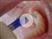 Video: Dental Sealants with Isolite