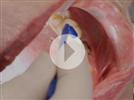 Video: Dental Cementation with Isolite