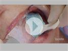 Video: Dental Impressions with Isolite