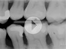 Video: Intraoral Case Studies Imaged with Suni Sensors
