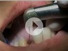 Video: BIOLASE - Waterlase MD Extraction