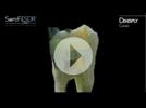 Video: DENTSPLY Caulk - SureFil&reg; SDR&reg;