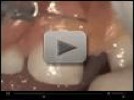 Video: AMD LASERS - Frenectomy on 4 years old, by Dr. Glenn van As