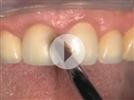 Video: Vertise Flow - Chapter 4 - Porcelain Repair