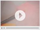 Video: AMD LASERS - Implant Recovery