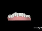 Narrow Arches With Recession And Abfraction Lesions