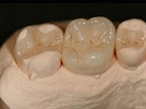 Crown and Bridge - The Right Material for the Case