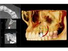 i-CAT® Precise™ Delivers Award-Winning Cone Beam 3D Technology  In A New System For Implants And Oral Surgery
