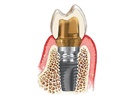 Study Up On Your Dental Implant Breakthroughs