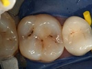 Small Cavities, Big Problems - Diagnosis and Treatment of Non-Cavitated Carious Lesions