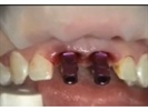 Periodontal Plastic Surgery: Case Studies, Videos, Resources
