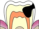 CAMBRA: The New Model for Managing Caries